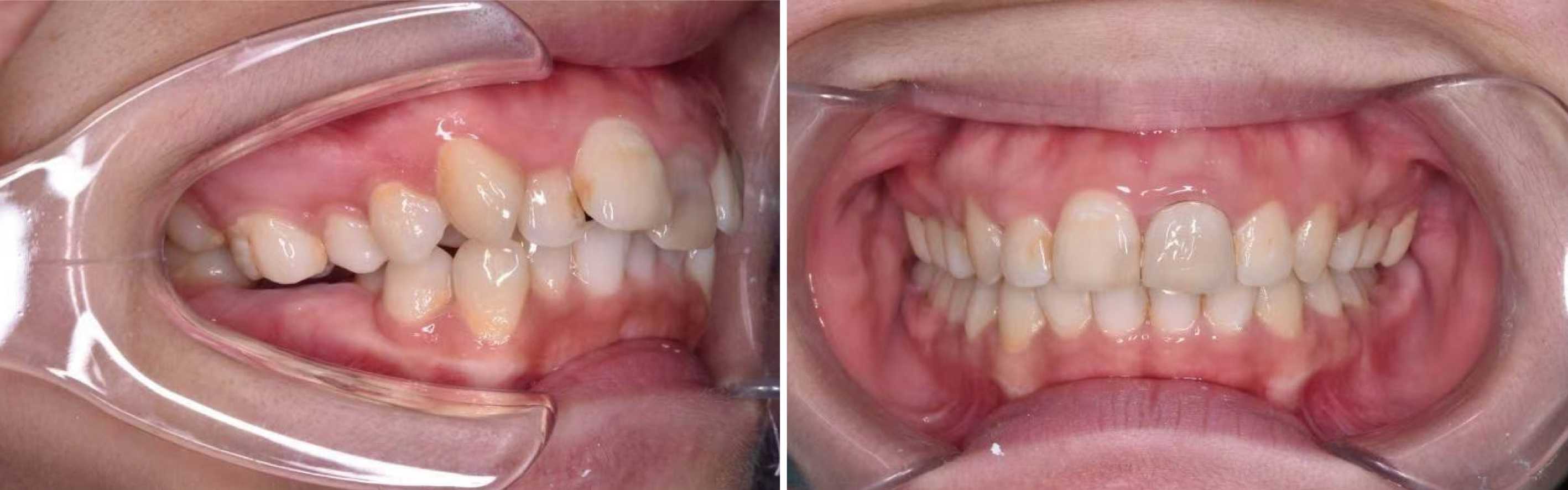 箍牙丨普通金屬托槽